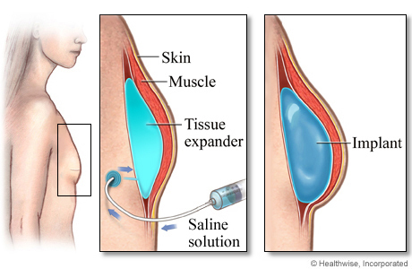 Inject steroids in chest